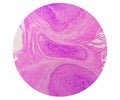 Photomicrography of Squamous hyperplasia