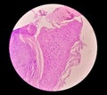 Photomicrography of Squamous hyperplasia