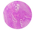 Photomicrography of Squamous hyperplasia