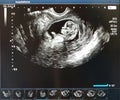 Photos of the child in the 12 week of pregnancy. Ultrasound procedure. Screening in the first trimester.