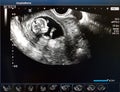 Photos of the child in the 12 week of pregnancy. Ultrasound procedure. Screening in the first trimester.