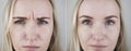 Photos before and after mesotherapy, biorevitalization, botulinum toxin injections. Skin fold between eyebrows, forehead wrinkles Royalty Free Stock Photo