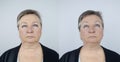 Second chin lift in senior woman. Photos before and after plastic surgery, mentoplasty or facebuilding. Chin fat removal and face Royalty Free Stock Photo