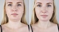 Second chin lift in women. Photos before and after plastic surgery, mentoplasty or facebuilding. Chin fat removal and face contour