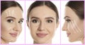 Photos of young woman with lifting marks on face against white background. Cosmetic surgery