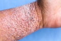 Atopic dermatitis AD, also known as atopic eczema, is a type of inflammation of the skin dermatitis. Royalty Free Stock Photo