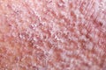 Atopic dermatitis AD, also known as atopic eczema, is a type of inflammation of the skin dermatitis. Royalty Free Stock Photo