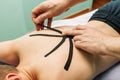 Physical therapist placing kinesio tape on patient s back Royalty Free Stock Photo