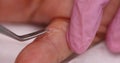 Physician uses tweezers to grasp piece of flaky skin