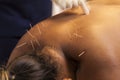A physiotherapist treating a woman with dry needling therapy.