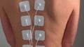 Physiotherapy of the back with TENS myostimulator, electrical nerve stimulation.