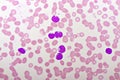 Picture of acute lymphocytic leukemia or ALL cells