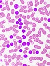 Picture of acute lymphocytic leukemia or ALL cells in blood smear Royalty Free Stock Photo