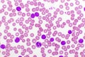 Picture of acute lymphocytic leukemia or ALL cells in blood smear