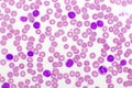 Picture of acute lymphocytic leukemia or ALL cells in blood smear