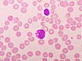 Picture of acute lymphocytic leukemia or ALL cells in blood smear Royalty Free Stock Photo