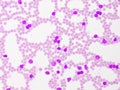 Picture of acute lymphocytic leukemia or ALL cells in blood smear Royalty Free Stock Photo