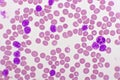 Picture of acute lymphocytic leukemia or ALL cells in blood smear Royalty Free Stock Photo