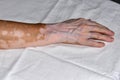 Woman& x27;s right hand damaged by vitiligo disease, side view. Royalty Free Stock Photo
