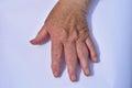 Right hand affected with arthrosis disease on white Royalty Free Stock Photo