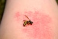 A wasp on an arm with a wasp sting Royalty Free Stock Photo