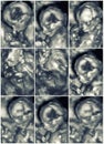 Pictures of 4D Ultrasound of baby in mother's womb. Collage of 3