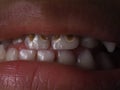 Pictures of kid`s rotten teeth