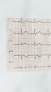 Piece of ECG paper, medical care for heart failure patients, showing normal sinus rhythm.