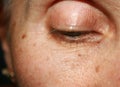 Pigmentation on the face. Brown spot. Wrinkles on the eyelid and under the eye