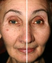 Pigmentation on the face. Brown spots and wrinkles on the skin of the face. Nasolabial folds. One half of the face is
