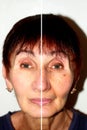 Pigmentation on the face. Brown spots and wrinkles on the skin of the face. Nasolabial folds. One half of the face is