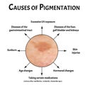 Pigmentation on the skin causes. Brown spots on the skin. Pigmentation treatment. Infographics. Vector illustration on