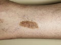 Pigmented birthmarks as a type of wart and pigment spots