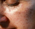 Pigmented spots on the face. Pigmentation on cheeks