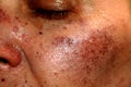 Pigmented spots on the face. Pigmentation on cheeks