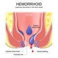 Piles. hemorrhoids. Cross section of the rectum and anal canal
