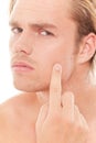 Pimple Royalty Free Stock Photo