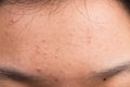 Pimple blackheads on the forehead Royalty Free Stock Photo