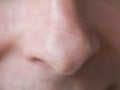 Pimple blackheads on the nose. Close up. Royalty Free Stock Photo