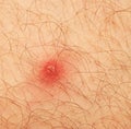 Pimple extreme on human skin. Royalty Free Stock Photo