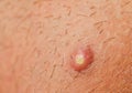 Pimple Extreme Macro Royalty Free Stock Photo