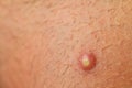 Pimple Extreme Macro Royalty Free Stock Photo