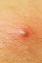 Pimple Extreme Macro Royalty Free Stock Photo