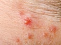 Pimple on human skin macro Royalty Free Stock Photo