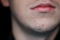 A pimple on a man`s face. Sore skin in humans. Close-up of lips and bristles.