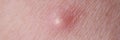 Pimple with purulent discharge on skin closeup