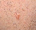 Pimple on the skin. Royalty Free Stock Photo