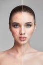 Pimples and acne on the woman`s face before and after. Cosmetics