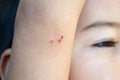 Pimples caused by drains fly on a kid arm Royalty Free Stock Photo