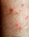 Pimples flea insect man feet